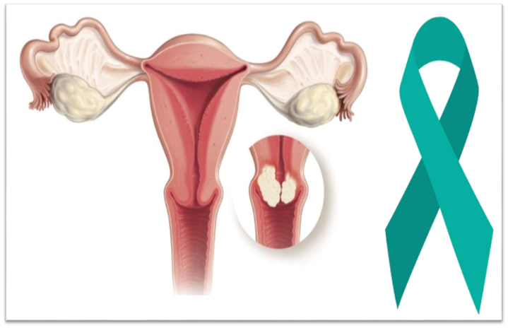 cancer-du-col